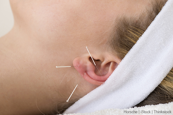 A photos shows a patient's ear with three acupuncture needles inserted